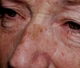 Melasma y léntigo, las manchas hiperpigmentadas más habituales
