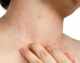 La psoriasis y el sistema inmunológico